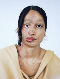 ACIDATTACKS.jpg
