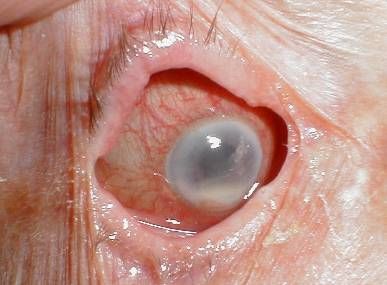 Eye%20Removal%20%201.jpg