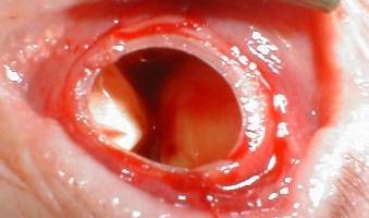Eye%20Removal%205.jpg