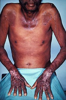 pellagra2.jpg