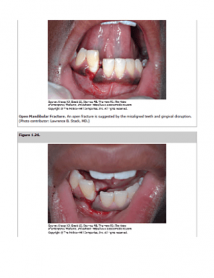 broken-20jaw.png