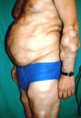 fatty-20lumps.gif