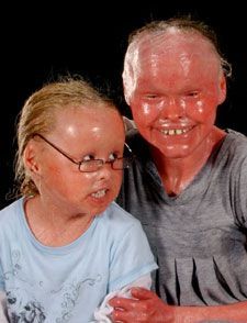 harlequin-ichthyosis-2001.jpg