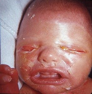 Harlequin-Ichthyosis%2002.jpg