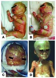 Harlequin-Ichthyosis%2003.jpg