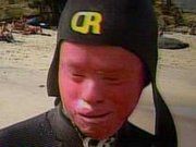 Harlequin-Ichthyosis%2005.jpg