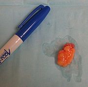 180px-Lipoma.jpg