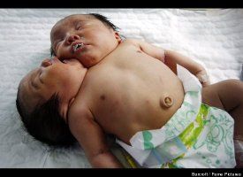 Conjoined%20Twins%2001.jpg