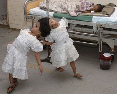 Conjoined%20Twins%2005.jpg