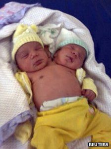 Conjoined%20Twins%2014.jpg