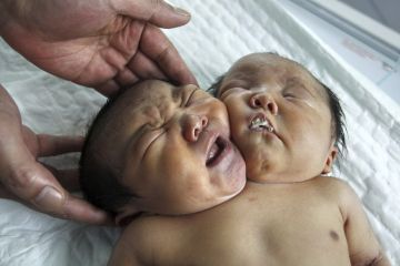 Conjoined%20Twins%2020.jpg