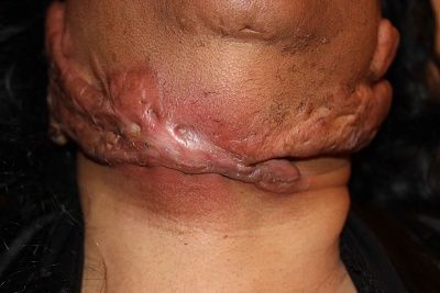 keloid-infection2.jpg