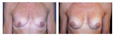 breast-augmentation_1356340307.jpg