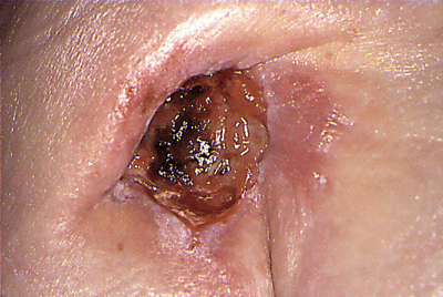 Decubitus%20Ulcer%2005.gif