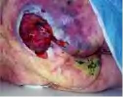 Decubitus%20Ulcer%2009.jpg