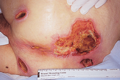 Decubitus%20Ulcer%2010.gif