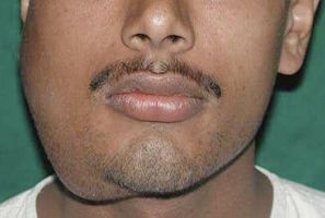 Name:  Ameloblastoma2.jpg
Views: 3508
Size:  11.8 KB