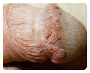 Name:  genital-warts-penis.jpeg
Views: 20174
Size:  37.0 KB