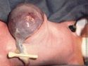 fetalsurgery-images-omphalocele1.jpg