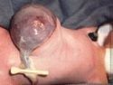 Omphalocele Photos, Omphalocele Pictures, Omphalocele Images: Exomphalos - fetalsurgery images omphalocele1