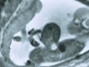fetalsurgery-images-omphalocele3.jpg