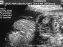 fetalsurgery-images-omphalocele2.jpg