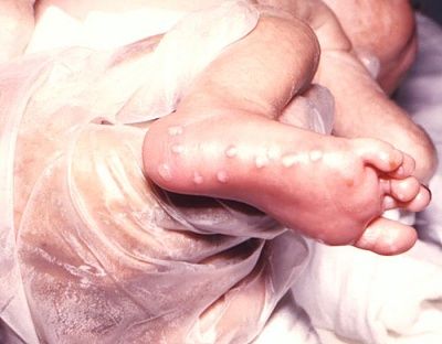 baby-20herpes.jpg