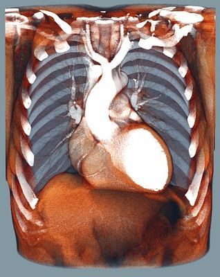 thoracic-20angiography-20showing-20the-20human-20heart.jpg