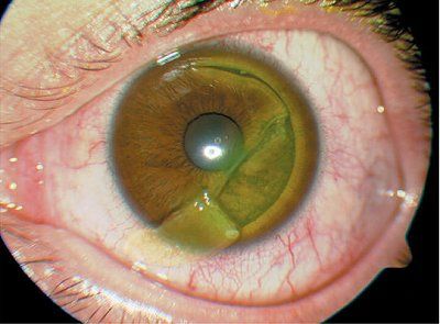 eye-laceration.jpg