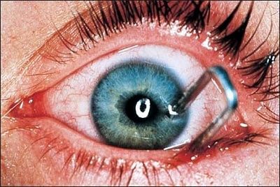 staple-20gun-20injury.jpg