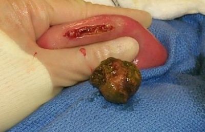 gallstone_ileus2.jpg
