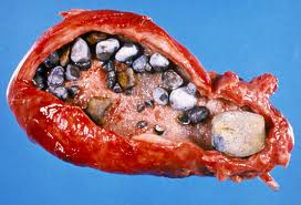 gallstones.jpg