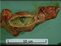 gallstones2.jpg