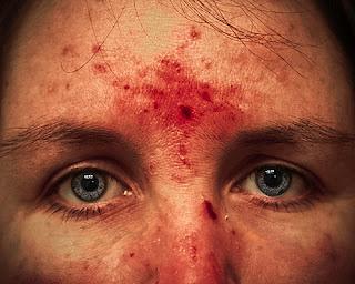 dermatillomania-L-08Ix01.jpeg