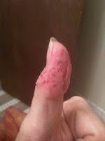 dermatillomania-L-N_PoQe.jpeg