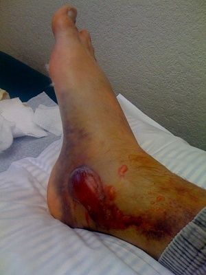 broken-foot-4-days-later.jpg