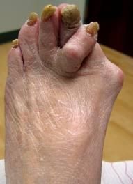 deformedfoot.jpg