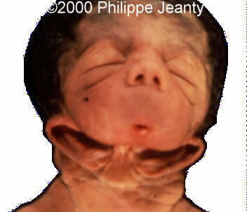 otocephaly.jpg