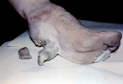 cutaneous-20horn-20on-20the-20sole-20of-20the-20left-20foot..jpg