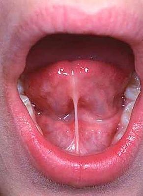 ankyloglossia-large.jpg