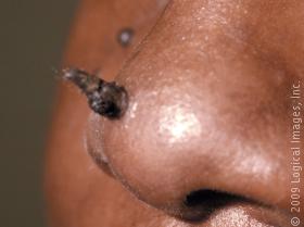cutaneoudhorns.jpg