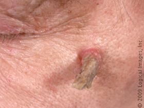 cutaneoushorn2.jpg