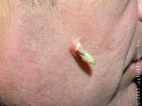 cutaneoushorn3.jpg