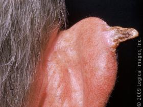 cutaneoushorn4.jpg
