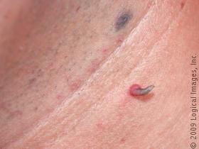 cutaneoushorn6.jpg