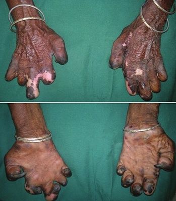 hansen-e2-80-99s-20disease.jpg