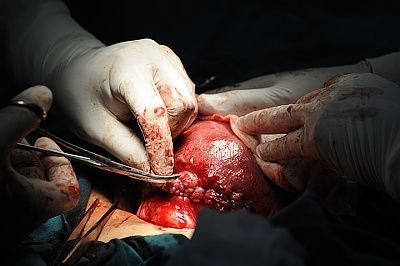 suturing-20the-20uterus-20after-20a-20c-section.jpg