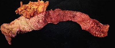 fulminant-20ulcerative-20colitis.jpg