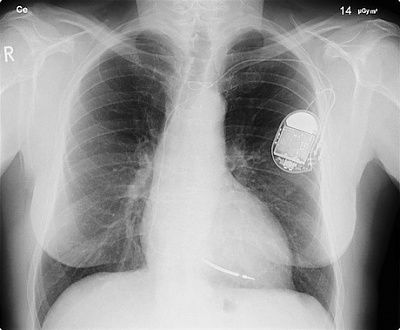 chest-20x-ray-20of-20a-20patient-20with-20a-20cardiac-20pacemaker.jpg