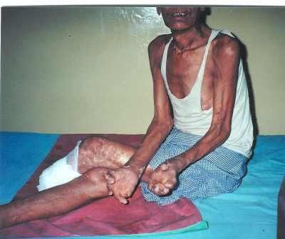 Leprosy2.jpg